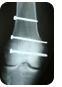 X-ray of leg bone with screws