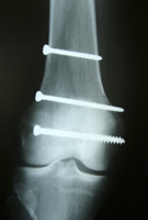 X-ray of leg bone with screws